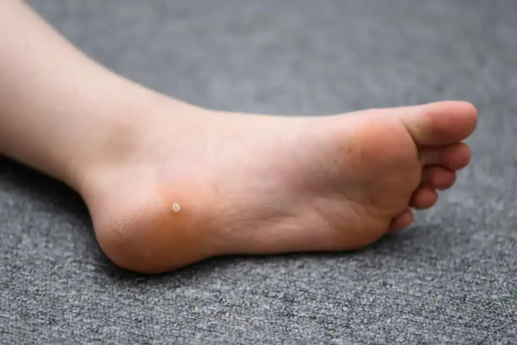 Cryotherapy For Warts And Also Verrucas 2 Image of verruca on the bottom of the foot that able to be treated with Cryotherapy