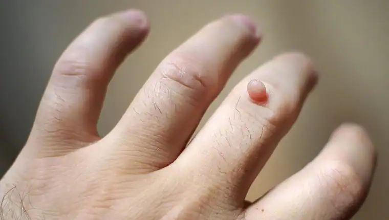 Cryotherapy For Warts And Also Verrucas 1 Image of blemish that Cryotherapy can remove with Lipo 360.