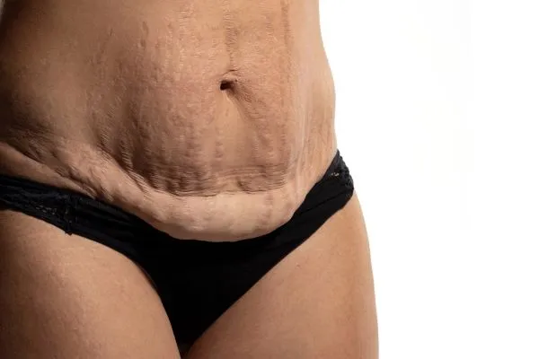 The Science of Skin Tightening 1 The science behind skin tightening picture of a woman's sagging skin on the stomach